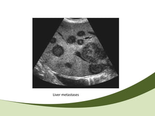 Liver metastases
 