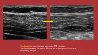 Tap Injection Ultrasound regional anesthesia | PPTX