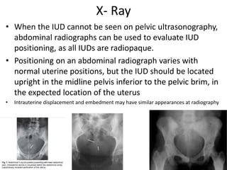 Role Of Ultrasound in assessment of iucd | PPTX