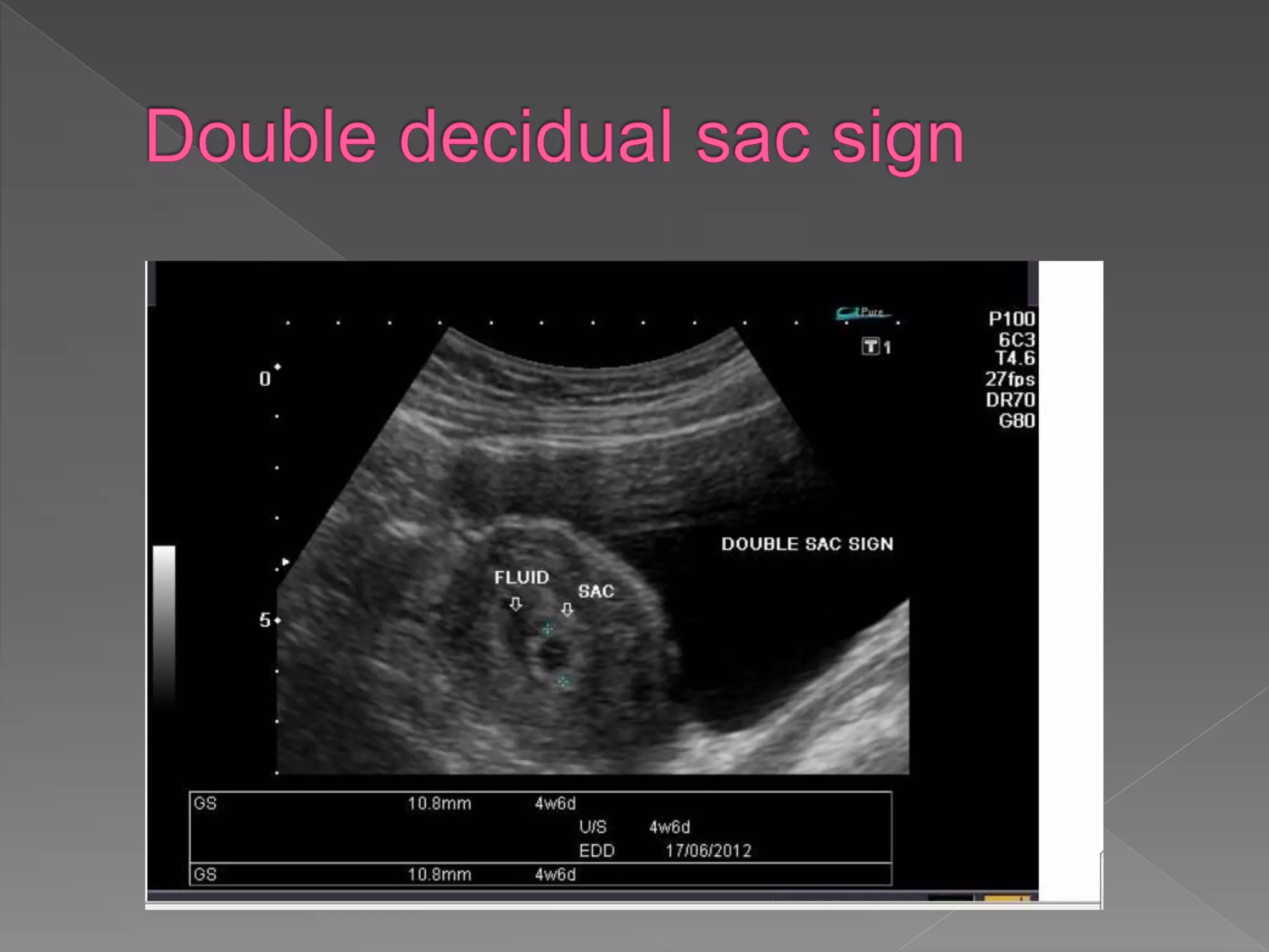 Ultrasound in obstetrics | PPTX