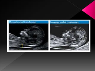 Ultrasound in obstetrics | PPTX