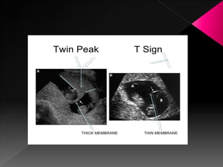 Ultrasound in obstetrics | PPTX