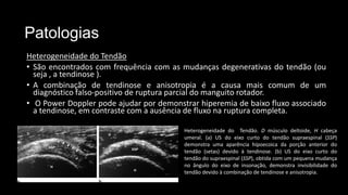 Patologias
Heterogeneidade do Tendão
• São encontrados com frequência com as mudanças degenerativas do tendão (ou
seja , a tendinose ).
• A combinação de tendinose e anisotropia é a causa mais comum de um
diagnóstico falso-positivo de ruptura parcial do manguito rotador.
• O Power Doppler pode ajudar por demonstrar hiperemia de baixo fluxo associado
a tendinose, em contraste com a ausência de fluxo na ruptura completa.
Heterogeneidade do Tendão. D músculo deltoide, H cabeça
umeral. (a) US do eixo curto do tendão supraespinal (SSP)
demonstra uma aparência hipoecoica da porção anterior do
tendão (setas) devido à tendinose. (b) US do eixo curto do
tendão do supraespinal (SSP), obtida com um pequena mudança
no ângulo do eixo de insonação, demonstra invisibilidade do
tendão devido à combinação de tendinose e anisotropia.
 