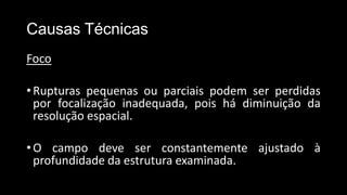 Causas Técnicas
Foco
•Rupturas pequenas ou parciais podem ser perdidas
por focalização inadequada, pois há diminuição da
resolução espacial.
•O campo deve ser constantemente ajustado à
profundidade da estrutura examinada.
 