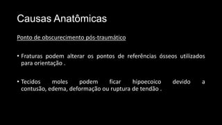 Causas Anatômicas
Ponto de obscurecimento pós-traumático
• Fraturas podem alterar os pontos de referências ósseos utilizados
para orientação .
• Tecidos moles podem ficar hipoecoico devido a
contusão, edema, deformação ou ruptura de tendão .
 