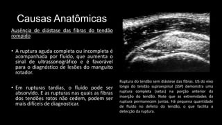 Causas Anatômicas
Ausência de diástase das fibras do tendão
rompido
• A ruptura aguda completa ou incompleta é
acompanhada por fluido, que aumenta o
sinal de ultrassonográfico e é favorável
para o diagnóstico de lesões do manguito
rotador.
• Em rupturas tardias, o fluido pode ser
absorvido. E as rupturas nas quais as fibras
dos tendões rotos não cedem, podem ser
mais difíceis de diagnosticar.
Ruptura do tendão sem diástese das fibras. US do eixo
longo do tendão supraespinal (SSP) demonstra uma
ruptura completa (setas) na porção anterior da
inserção do tendão. Note que as extremidades da
ruptura permanecem juntas. Há pequena quantidade
de fluido no defeito do tendão, o que facilita a
detecção da ruptura.
 