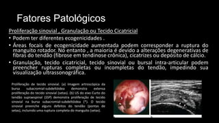 Fatores Patológicos
Proliferação sinovial , Granulação ou Tecido Cicatricial
• Podem ter diferentes ecogenicidades .
• Áreas focais de ecogenicidade aumentada podem corresponder a ruptura do
manguito rotador. No entanto , a maioria é devido a alterações degenerativas de
fibras do tendão (fibrose em tendinose crônica), cicatrizes ou depósito de cálcio.
• Granulação, tecido cicatricial, tecido sinovial ou bursal intra-articular podem
preencher rupturas completas ou incompletas do tendão, impedindo sua
visualização ultrassonográfica.
Proliferação de tecido sinovial. (a) Imagem artroscópica da
bursa subacromial-subdeltóidea demonstra extensa
proliferação do tecido sinovial (setas). (b) US do eixo Curto do
tendão supraespinal (SSP) demonstra proliferação de tecido
sinovial na bursa subacromial-subdeltóidea (*). O tecido
sinovial preenche alguns defeitos do tendão (pontas de
setas), incluindo uma ruptura completa do manguito (setas).
 