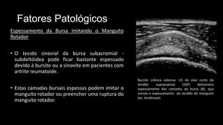 Fatores Patológicos
Espessamento da Bursa Imitando o Manguito
Rotador
• O tecido sinovial da bursa subacromial -
subdeltóidea pode ficar bastante espessado
devido à bursite ou a sinovite em pacientes com
artrite reumatoide.
• Estas camadas bursais espessas podem imitar o
manguito rotador ou preencher uma ruptura do
manguito rotador.
Bursite crônica extensa. US do eixo curto do
tendão supraespinal (SSP) demonstra
espessamento das camadas da bursa (B), que
simula o espessamento do tendão do manguito
(ex. tendinose).
 