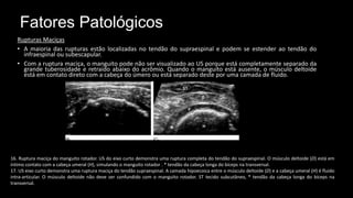 Fatores Patológicos
Rupturas Maciças
• A maioria das rupturas estão localizadas no tendão do supraespinal e podem se estender ao tendão do
infraespinal ou subescapular.
• Com a ruptura maciça, o manguito pode não ser visualizado ao US porque está completamente separado da
grande tuberosidade e retraído abaixo do acrômio. Quando o manguito está ausente, o músculo deltoide
está em contato direto com a cabeça do úmero ou está separado deste por uma camada de fluido.
16. Ruptura maciça do manguito rotador. US do eixo curto demonstra uma ruptura completa do tendão do supraespinal. O músculo deltoide (D) está em
íntimo contato com a cabeça umeral (H), simulando o manguito rotador . * tendão da cabeça longa do bíceps na transversal.
17. US eixo curto demonstra uma ruptura maciça do tendão supraespinal. A camada hipoecoica entre o músculo deltoide (D) e a cabeça umeral (H) é fluido
intra-articular. O músculo deltoide não deve ser confundido com o manguito rotador. ST tecido subcutâneo, * tendão da cabeça longa do bíceps na
transversal.
 