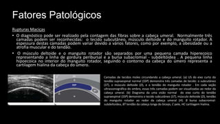 Fatores Patológicos
Rupturas Maciças
• O diagnóstico pode ser realizado pela contagem das fibras sobre a cabeça umeral. Normalmente três
camadas podem ser reconhecidas: o tecido subcutâneo, músculo deltoide e do manguito rotador. A
espessura destas camadas podem variar devido a vários fatores, como por exemplo, a obesidade ou a
atrofia muscular e do tendão.
• O músculo deltoide e o manguito rotador são separados por uma pequena camada hiperecoico
representando a linha de gordura peribursal e a bursa subacromial - subdeltóidea . A pequena linha
hipoecoica no interior do manguito rotador, seguindo o contorno da cabeça do úmero representa a
cartilagem hialina da cabeça do úmero.
Camadas de tecidos moles circundando a cabeça umeral. (a) US do eixo curto do
tendão supraespinal normal (SSP) demonstra três camadas de tecido: o subcutâneo
(ST), o músculo deltoide (D), e o tendão do manguito rotador . Em cada seção
ultrassonográfica do ombro, essas três camadas podem ser visualizadas ao redor da
cabeça umeral. (b) Diagrama da uma visão normal do eixo curto do tendão
supraespinal (SSP) demonstra o tecido subcutâneo (ST), músculo deltoide (D), tendão
do manguito rotador ao redor da cabeça umeral (H). B bursa subacromial-
subdeltoidea, BT tendão da cabeça longa do bíceps, C pele, HC cartilagem hialina.
 