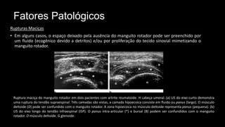 Fatores Patológicos
Rupturas Maciças
• Em alguns casos, o espaço deixado pela ausência do manguito rotador pode ser preenchido por
um fluido (ecogênico devido a detritos) e/ou por proliferação do tecido sinovial mimetizando o
manguito rotador.
Ruptura maciça do manguito rotador em dois pacientes com artrite reumatoide. H cabeça umeral. (a) US do eixo curto demonstra
uma ruptura do tendão supraespinal. Três camadas são vistas, a camada hipoecoica consiste em fluido ou panus (largo). O músculo
deltoide (D) pode ser confundido com o manguito rotador. A zona hipoecoica no músculo deltoide representa panus (pequena). (b)
US do eixo longo do tendão infraespinal (ISP). O panus intra-articular (*) e bursal (B) podem ser confundidos com o manguito
rotador. D músculo deltoide. G glenoide.
 