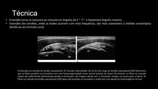 Técnica
• O tendão torna-se isoecoico ao músculo em ângulos de 2 ° -7 ° e hipoecoico ângulos maiores.
• Inserções dos tendões, onde as lesões ocorrem com mais frequência, são mais vulneráveis ​​à artefato anisotrópico
devido ao seu formato curvo.
Anisotropia na inserção do tendão supraespinal. GT: Grande tuberosidade. (a) US do eixo longo do tendão supraespinal (SSP) demonstra
que as fibras paralelas ao transdutor tem uma hiperecogenicidade linear normal (pontas de setas). No entanto, as fibras na inserção
(setas) são pobremente demonstrada devido à anisotropia. (b) Imagem obtida com o transdutor movido um pouco para a lateral. As
fibras na inserção do tendão supraespinal (SSP) agora são paralelas ao transdutor e então tem uma aparência hiperecogênica normal.
 