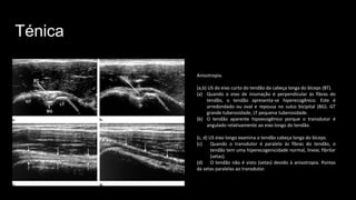 Ténica
Anisotropia.
(a,b) US do eixo curto do tendão da cabeça longa do bíceps (BT).
(a) Quando o eixo de insonação é perpendicular às fibras do
tendão, o tendão apresenta-se hiperecogênico. Este é
arredondado ou oval e repousa no sulco bicipital (BG). GT
grande tuberosidade, LT pequena tuberosidade.
(b) O tendão aparente hipoecogênico porque o transdutor é
angulado relativamente ao eixo longo do tendão.
(c, d) US eixo longo examina o tendão cabeça longa do bíceps.
(c) Quando o transdutor é paralelo às fibras do tendão, o
tendão tem uma hiperecogenicidade normal, linear, fibrilar
(setas).
(d) O tendão não é visto (setas) devido à anisotropia. Pontas
da setas paralelas ao transdutor.
 