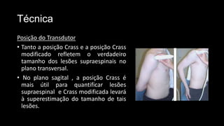 Técnica
Posição do Transdutor
• Tanto a posição Crass e a posição Crass
modificado refletem o verdadeiro
tamanho dos lesões supraespinais no
plano transversal.
• No plano sagital , a posição Crass é
mais útil para quantificar lesões
supraespinal e Crass modificada levará
à superestimação do tamanho de tais
lesões.
 