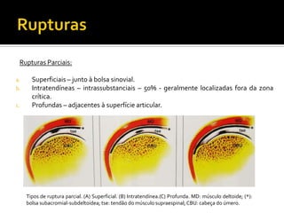 Rupturas Parciais:
a. Superficiais – junto à bolsa sinovial.
b. Intratendíneas – intrassubstanciais – 50% - geralmente localizadas fora da zona
crítica.
c. Profundas – adjacentes à superfície articular.
Tipos de ruptura parcial. (A) Superficial. (B) Intratendínea.(C) Profunda. MD: músculo deltoide; (*):
bolsa subacromial-subdeltoidea; tse: tendão do músculo supraespinal; CBU: cabeça do úmero.
 