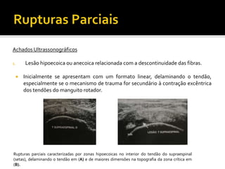 Achados Ultrassonográficos
1. Lesão hipoecoica ou anecoica relacionada com a descontinuidade das fibras.
 Inicialmente se apresentam com um formato linear, delaminando o tendão,
especialmente se o mecanismo de trauma for secundário à contração excêntrica
dos tendões do manguito rotador.
Rupturas parciais caracterizadas por zonas hipoecoicas no interior do tendão do supraespinal
(setas), delaminando o tendão em (A) e de maiores dimensões na topografia da zona crítica em
(B).
 