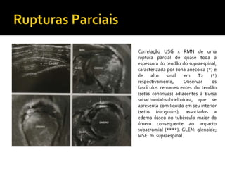 Correlação USG x RMN de uma
ruptura parcial de quase toda a
espessura do tendão do supraespinal,
caracterizada por zona anecoica (*) e
de alto sinal em T2 (*)
respectivamente, Observar os
fascículos remanescentes do tendão
(setas contínuas) adjacentes à Bursa
subacromial-subdeltoidea, que se
apresenta com líquido em seu interior
(setas tracejadas), associados a
edema ósseo no tubérculo maior do
úmero consequente ao impacto
subacromial (****). GLEN: glenoide;
MSE: m. supraespinal.
 