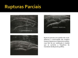 Rupturas parciais com padrão não usual.
Observar a continuidade das imagens
lineares hipoecoica e hiperecoica (setas),
mais fácil de ser visibilizada à medida
que se aumenta a frequência do
transdutor de A para C (15 MHz).
 
