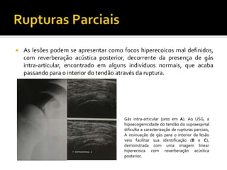  As lesões podem se apresentar como focos hiperecoicos mal definidos,
com reverberação acústica posterior, decorrente da presença de gás
intra-articular, encontrado em alguns indivíduos normais, que acaba
passando para o interior do tendão através da ruptura.
Gás intra-articular (seta em A). Ao USG, a
hipoecogenicidade do tendão do supraespinal
dificulta a caracterização de rupturas parciais,
A insinuação de gás para o interior da lesão
veio facilitar sua identificação (B e C),
demonstrada com uma imagem linear
hiperecoica com reverberação acústica
posterior.
 