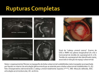 Sinal da “cabeça umeral careca”. Exame de
USG e RMN nos planos longitudinal (A e B) e
transversal do tendão do supraespinal (C e D).
Tendão do supraespinal não identificado (seta),
associado à redução do espaço subacromial.
Notar o espessamento/ fibrose na topografia da bolsa subacromial-subdeltóidea (seta tracejada) acompanhada
por líquido no interior da articulação glenoumeral que se estende para a bolsa subacromial-subdeltoidea (*); (E)
foto intraoperatória demonstrando a cabeça umeral totalmente exposta (****). MD: Músculo deltoide; AAC:
articulação acromioclavicular; AC: acrômio.
 