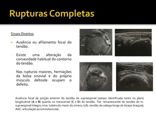 Sinais Direitos
 Ausência ou afilamento focal do
tendão.
- Existe uma alteração da
convexidade habitual do contorno
do tendão.
- Nas rupturas maiores, herniações
da bolsa sinovial e do próprio
músculo deltoide ocupam o
defeito.
Ausência focal da porção anterior do tendão do supraespinal (setas0 identificada tanto no plano
longitudinal (A e B) quanto no transversal (C e D) do tendão. Tse: remanescente do tendão do m.
supraespinal íntegro; tma: tubérculo maior do úmero; tclb: tendão da cabeça longa do bíceps braquial;
AAC: articulação acromioclavicular.
 