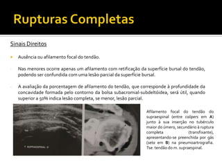 Sinais Direitos
 Ausência ou afilamento focal do tendão.
- Nas menores ocorre apenas um afilamento com retificação da superfície bursal do tendão,
podendo ser confundida com uma lesão parcial da superfície bursal.
- A avaliação da porcentagem de afilamento do tendão, que corresponde à profundidade da
concavidade formada pelo contorno da bolsa subacromial-subdeltóidea, será útil, quando
superior a 50% indica lesão completa, se menor, lesão parcial.
Afilamento focal do tendão do
supraespinal (entre calipers em A)
junto à sua inserção no tubérculo
maior do úmero, secundário à ruptura
completa (transfixante),
apresentando-se preenchida por gás
(seta em B) na pneumoartrografia.
Tse: tendão do m. supraespinal.
 