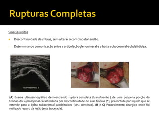 Sinais Direitos
 Descontinuidade das fibras, sem alterar o contorno do tendão.
- Determinando comunicação entre a articulação glenoumeral e a bolsa subacromial-subdeltóidea.
(A) Exame ultrassonográfico demosntrando ruptura completa (transfixante ) de uma pequena porção do
tendão do supraespinal caracterizada por descontinuidade de suas fiobras (*), preenchida por líquido que se
estende para a bolsa subacromial-subdeltoidea (seta contínua). (B e C) Procedimento cirúrgico onde foi
realizado reparo da lesão (seta tracejada).
 