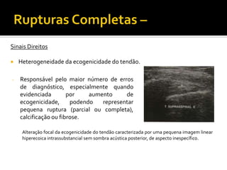 Sinais Direitos
 Heterogeneidade da ecogenicidade do tendão.
- Responsável pelo maior número de erros
de diagnóstico, especialmente quando
evidenciada por aumento de
ecogenicidade, podendo representar
pequena ruptura (parcial ou completa),
calcificação ou fibrose.
Alteração focal da ecogenicidade do tendão caracterizada por uma pequena imagem linear
hiperecoica intrassubstancial sem sombra acústica posterior, de aspecto inespecífico.
 