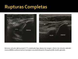 Derrame articular glenoumeral (***) visibilizado logo abaixo da margem inferior do músculo redondo
menor (MRM) e anteriormente à transição musculotendínea do infraespinal (MI). GLEN: glenoide.
 