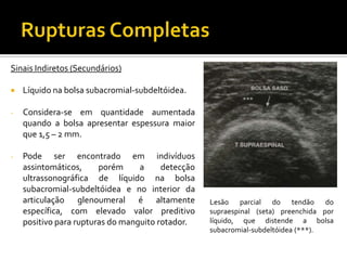 Sinais Indiretos (Secundários)
 Líquido na bolsa subacromial-subdeltóidea.
- Considera-se em quantidade aumentada
quando a bolsa apresentar espessura maior
que 1,5 – 2 mm.
- Pode ser encontrado em indivíduos
assintomáticos, porém a detecção
ultrassonográfica de líquido na bolsa
subacromial-subdeltóidea e no interior da
articulação glenoumeral é altamente
específica, com elevado valor preditivo
positivo para rupturas do manguito rotador.
Lesão parcial do tendão do
supraespinal (seta) preenchida por
líquido, que distende a bolsa
subacromial-subdeltóidea (***).
 