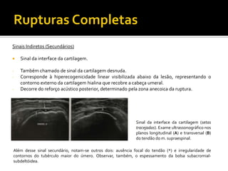 Sinais Indiretos (Secundários)
 Sinal da interface da cartilagem.
- Também chamado de sinal da cartilagem desnuda.
- Corresponde à hiperecogenicidade linear visibilizada abaixo da lesão, representando o
contorno externo da cartilagem hialina que recobre a cabeça umeral.
- Decorre do reforço acústico posterior, determinado pela zona anecoica da ruptura.
Sinal da interface da cartilagem (setas
tracejadas). Exame ultrassonográfico nos
planos longitudinal (A) e transversal (B)
do tendão do m. supraespinal.
Além desse sinal secundário, notam-se outros dois: ausência focal do tendão (*) e irregularidade de
contornos do tubérculo maior do úmero. Observar, também, o espessamento da bolsa subacromial-
subdeltóidea.
 