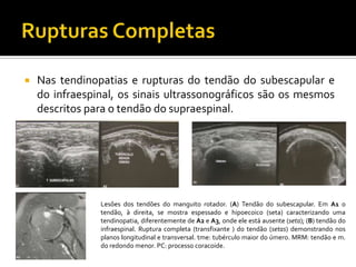  Nas tendinopatias e rupturas do tendão do subescapular e
do infraespinal, os sinais ultrassonográficos são os mesmos
descritos para o tendão do supraespinal.
Lesões dos tendões do manguito rotador. (A) Tendão do subescapular. Em A1 o
tendão, à direita, se mostra espessado e hipoecoico (seta) caracterizando uma
tendinopatia, diferentemente de A2 e A3, onde ele está ausente (seta); (B) tendão do
infraespinal. Ruptura completa (transfixante ) do tendão (setas) demonstrando nos
planos longitudinal e transversal. tme: tubérculo maior do úmero. MRM: tendão e m.
do redondo menor. PC: processo coracoide.
 