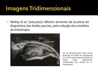  Wallny et al. (200;2001) referem aumento da acurácia do
diagnóstico das lesões parciais, pela redução dos artefatos
de anisotropia.
US 3D demonstrando lesão parcial
profunda no tendão do supraespinal
(**). GPS: gordura peribursal; BOLSA
SASD: bolsa subacromial-
subdeltóidea; tse: tendão do m.
supraespinal.
 