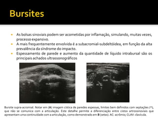  As bolsas sinoviais podem ser acometidas por inflamação, simulando, muitas vezes,
processo expansivo.
 A mais frequentemente envolvida é a subacromial-subdeltóidea, em função da alta
prevalência da síndrome do impacto.
 Espessamento de parede e aumento da quantidade de líquido intrabursal são os
principais achados ultrassonográficos
Bursite supra-acromial. Notar em (A) imagem cística de paredes espessas, limites bem definidos com septações (*),
que não se comunica com a articulação. Este detalhe permite a diferenciação entre cistos artrossinoviais que
apresentam uma continuidade com a articulação, como demonstrado em B (setas). AC: acrômio; CLAV: clavícula.
 