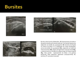 Bursite subacromial-subdetoidea. (A) Espessamento da bolsa e
da gordura peribursal caracterizado por uma banda hiperecoica
adjacente ao tendão do supraespinal. (B) Aumento de líquido
no interior da bolsa (***) visibilizado em várias localizações:
acima do tendão do supraespinal (B1), adjacente ao tubérculo
maior do úmero (B2), abaixo do ligamento coracoacromial (B3),
e anteriormente ao tendão da cabeça longa do bíceps braquial
(B4). Seta grande : espessamento da bolsa e da gordura
peribursal; setas pequenas: ligamento coracoacromial; AC:
acrômio; PC: processo coracoide.
 