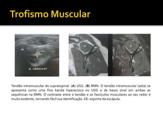 Tendão intramuscular do supraespinal. (A) USG. (B) RMN. O tendão intramuscular (seta) se
apresenta como uma fina banda hiperecoica no USG e de baixo sinal em ambas as
sequências na RMN. O contraste entre o tendão e os fascículos musculares ao seu redor é
muito evidente, tornando fácil sua identificação. EE: espinha da escápula.
 