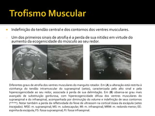  Indefinição do tendão central e dos contornos dos ventres musculares.
- Um dos primeiros sinais de atrofia é a perda de sua nitidez em virtude do
aumento da ecogenicidade do músculo ao seu redor.
Diferentes graus de atrofia dos ventres musculares do manguito rotador. Em (A) a alteração está restrita à
vizinhança do tendão intramuscular do supraespinal (setas), caracterizada pelo alto sinal e pela
hiperecogenicidade ao seu redor, associada à perda de sua delimitação. Em (B) observa-se grau mais
avançado de substituição gordurosa, com hiperecogenicidade difusa dos ventres musculares do
supraespinal e do infraespinal, acompanhada por diminuição do volume e indefinição de seus contornos
(****). Notar também a perda da refletividade do feixe de ultrassom na cortical óssea da escápula (setas
tracejadas). MSE: m. supraespinal; MS: m. subescapular; MI: m. infraespinal; MRM: m. redondo menor; EE:
espinha da escápula; FS: fossa supraespinal; FI: fossa infraespinal.
 