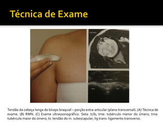 Tendão da cabeça longa do bíceps braquial – porção extra-articular (plano transversal). (A) Técnica de
exame. (B) RMN. (C) Exame ultrassonográfico. Seta: tclb; tme: tubérculo menor do úmero; tma:
tubérculo maior do úmero; ts: tendão do m. subescapular; lig trans: ligamento transverso.
 