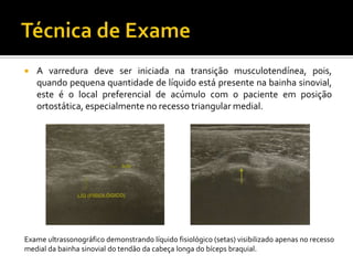  A varredura deve ser iniciada na transição musculotendínea, pois,
quando pequena quantidade de líquido está presente na bainha sinovial,
este é o local preferencial de acúmulo com o paciente em posição
ortostática, especialmente no recesso triangular medial.
Exame ultrassonográfico demonstrando líquido fisiológico (setas) visibilizado apenas no recesso
medial da bainha sinovial do tendão da cabeça longa do bíceps braquial.
 
