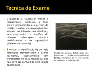  Deslocando o transdutor cranial e
medialmente, mantendo o feixe
sonoro perpendicular à superfície do
tendão, visualiza-se a sua porção intra-
articular no intervalo dos rotadores,
interposta entre os tendões do
músculo subescapular (ântero-
medialmente) e do supraespinal
(póstero-lateralmente).
 É comum a identificação de um halo
hipoecoico representando a bainha
ligamentar, especialmente com
transdutores de baixa frequência, que
não deve ser confundido com líquido
peritendíneo .
Porção intra-articular do tclb. Notar halo
hipoecoico (**) artefatual circundando o
tendão. Tse: tendão do m. supraespina;
ts: tendão do m. subescapular.
 