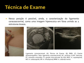  Nessa posição é possível, ainda, a caracterização do ligamento
coracoacromial, como uma imagem hiperecoica em faixa unindo as 2
estruturas ósseas.
Ligamento coracoacromial. (A) Técnica de Exame. (B) RMN. (C) Exame
ultrassonográfico. Seta: ligamento coracoacromial; AC: acrômio; CLAV: clavícula;
PC: processo coracoide; (*): porção intra-articular do tclb; MSE: m. supraespinal;
MS: m. subescapular; MI: m. infraespinal; MRM: m. redondo menor.
 