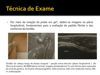  Por meio da rotação do probe em 90°, obtêm-se imagens no plano
longitudinal, fundamentais para a avaliação do padrão fibrilar e dos
contornos do tendão.
Tendão da cabeça longa do bíceps braquial – porção extra-articular (plano longitudinal ). (A)
Técnica de exame. (B) RMN plano coronal, imagem ponderada em T2 com técnica para supressão
do sinal de gordura. (C) Exame ultrassonográfico. Seta contínua: tclb; tme: tubérculo menor; MS:
m. subescapular.
 