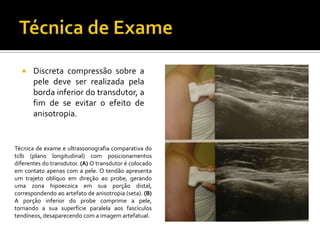  Discreta compressão sobre a
pele deve ser realizada pela
borda inferior do transdutor, a
fim de se evitar o efeito de
anisotropia.
Técnica de exame e ultrassonografia comparativa do
tclb (plano longitudinal) com posicionamentos
diferentes do transdutor. (A) O transdutor é colocado
em contato apenas com a pele. O tendão apresenta
um trajeto oblíquo em direção ao probe, gerando
uma zona hipoecoica em sua porção distal,
correspondendo ao artefato de anisotropia (seta). (B)
A porção inferior do probe comprime a pele,
tornando a sua superfície paralela aos fascículos
tendíneos, desaparecendo com a imagem artefatual.
 