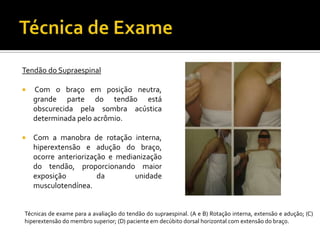 Tendão do Supraespinal
 Com o braço em posição neutra,
grande parte do tendão está
obscurecida pela sombra acústica
determinada pelo acrômio.
 Com a manobra de rotação interna,
hiperextensão e adução do braço,
ocorre anteriorização e medianização
do tendão, proporcionando maior
exposição da unidade
musculotendínea.
Técnicas de exame para a avaliação do tendão do supraespinal. (A e B) Rotação interna, extensão e adução; (C)
hiperextensão do membro superior; (D) paciente em decúbito dorsal horizontal com extensão do braço.
 