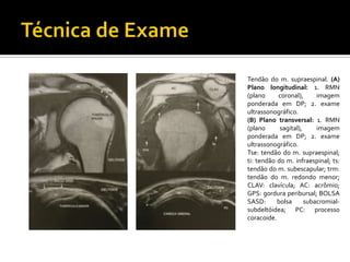 Tendão do m. supraespinal. (A)
Plano longitudinal: 1. RMN
(plano coronal), imagem
ponderada em DP; 2. exame
ultrassonográfico.
(B) Plano transversal: 1. RMN
(plano sagital), imagem
ponderada em DP; 2. exame
ultrassonográfico.
Tse: tendão do m. supraespinal;
ti: tendão do m. infraespinal; ts:
tendão do m. subescapular; trm:
tendão do m. redondo menor;
CLAV: clavícula; AC: acrômio;
GPS: gordura peribursal; BOLSA
SASD: bolsa subacromial-
subdeltóidea; PC: processo
coracoide.
 