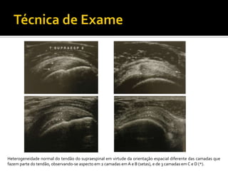 Heterogeneidade normal do tendão do supraespinal em virtude da orientação espacial diferente das camadas que
fazem parte do tendão, observando-se aspecto em 2 camadas em A e B (setas), e de 3 camadas em C e D (*).
 