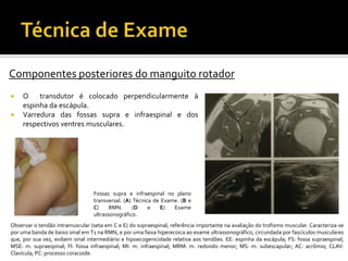  O transdutor é colocado perpendicularmente à
espinha da escápula.
 Varredura das fossas supra e infraespinal e dos
respectivos ventres musculares.
Componentes posteriores do manguito rotador
Fossas supra e infraespinal no plano
transversal. (A) Técnica de Exame. (B e
C) RMN. (D e E) Exame
ultrassonográfico.
Observar o tendão intramuscular (seta em C e E) do supraespinal, referência importante na avaliação do trofismo muscular. Caracteriza-se
por uma banda de baixo sinal em T1 na RMN, e por uma faixa hiperecoica ao exame ultrassonográfico, circundada por fascículos musculares
que, por sua vez, exibem sinal intermediário e hipoecogenicidade relativa aos tendões. EE: espinha da escápula; FS: fossa supraespinal;
MSE: m. supraespinal; FI: fossa infraespinal; MI: m. infraespinal; MRM: m. redondo menor; MS: m. subescapular; AC: acrômio; CLAV:
Clavícula; PC: processo coracoide.
 