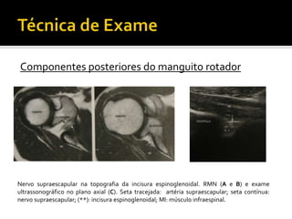 Componentes posteriores do manguito rotador
Nervo supraescapular na topografia da incisura espinoglenoidal. RMN (A e B) e exame
ultrassonográfico no plano axial (C). Seta tracejada: artéria supraescapular; seta contínua:
nervo supraescapular; (**): incisura espinoglenoidal; MI: músculo infraespinal.
 