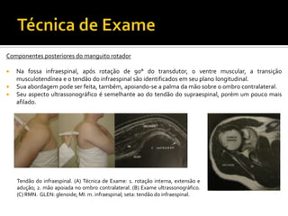 Componentes posteriores do manguito rotador
 Na fossa infraespinal, após rotação de 90° do transdutor, o ventre muscular, a transição
musculotendínea e o tendão do infraespinal são identificados em seu plano longitudinal.
 Sua abordagem pode ser feita, também, apoiando-se a palma da mão sobre o ombro contralateral.
 Seu aspecto ultrassonográfico é semelhante ao do tendão do supraespinal, porém um pouco mais
afilado.
Tendão do infraespinal. (A) Técnica de Exame: 1. rotação interna, extensão e
adução; 2. mão apoiada no ombro contralateral. (B) Exame ultrassonográfico.
(C) RMN. GLEN: glenoide; MI: m. infraespinal; seta: tendão do infraespinal.
 