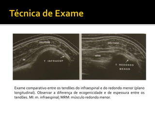 Exame comparativo entre os tendões do infraespinal e do redondo menor (plano
longitudinal). Observar a diferença de ecogenicidade e de espessura entre os
tendões. MI: m. infraespinal; MRM: músculo redondo menor.
 